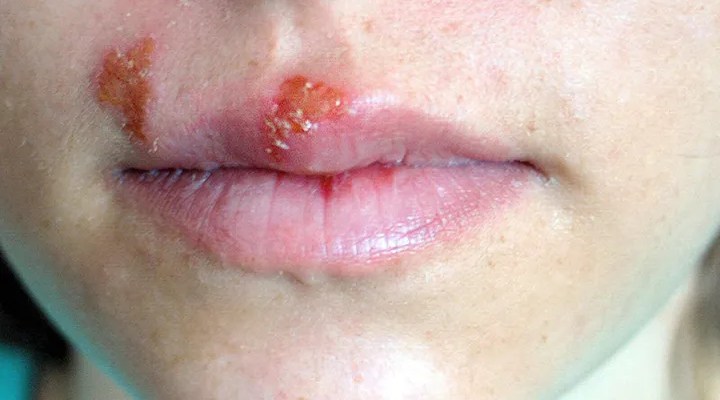 What Does Herpes Look Like? A Clear and Simple Guide