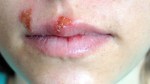 What Does Herpes Look Like? A Clear and Simple Guide